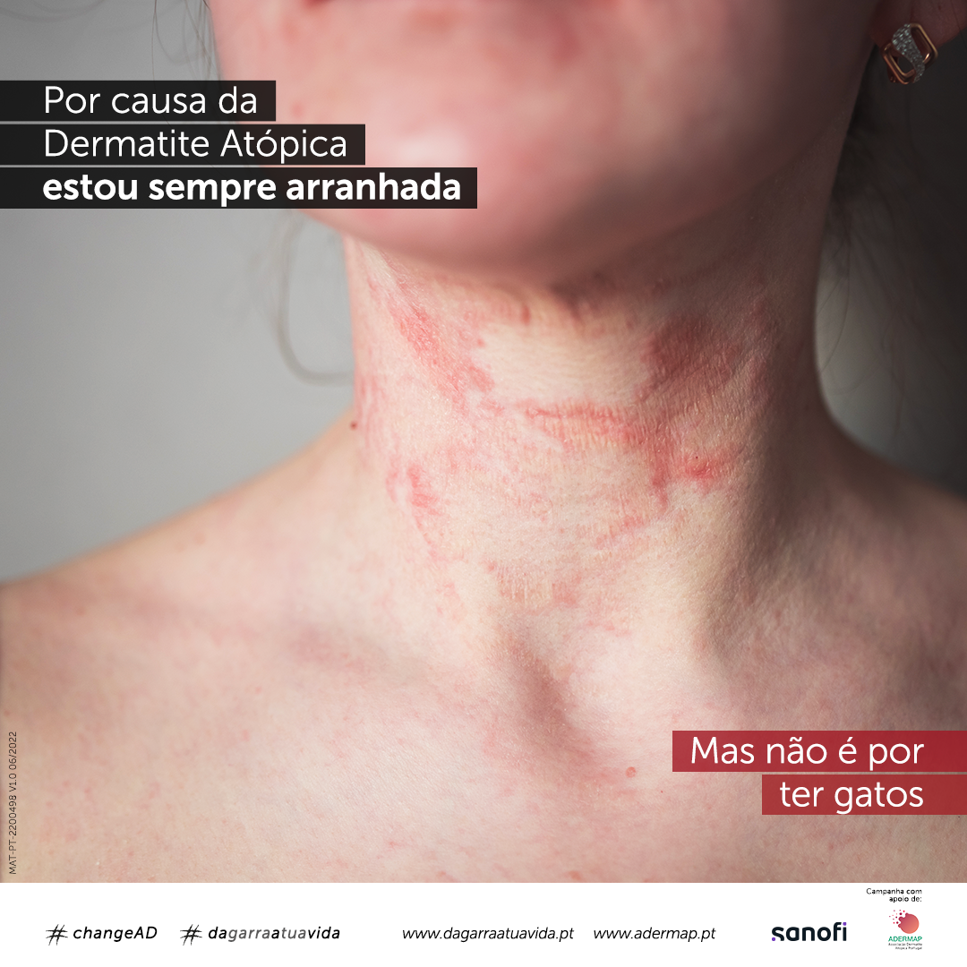 Campanha Alerta Para Consequ Ncias F Sicas E Emocionais Da Dermatite